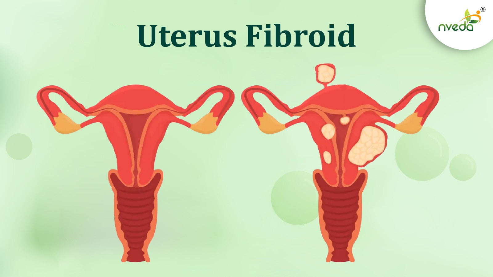 Understanding Uterine Fibroids: What Every Woman Should Know